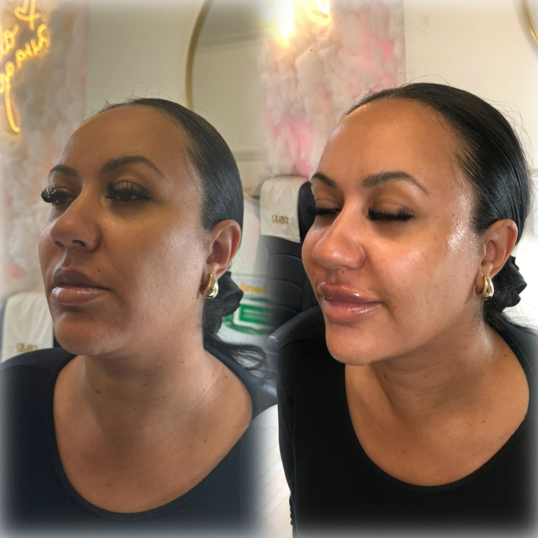 The OA Face Lift treatment